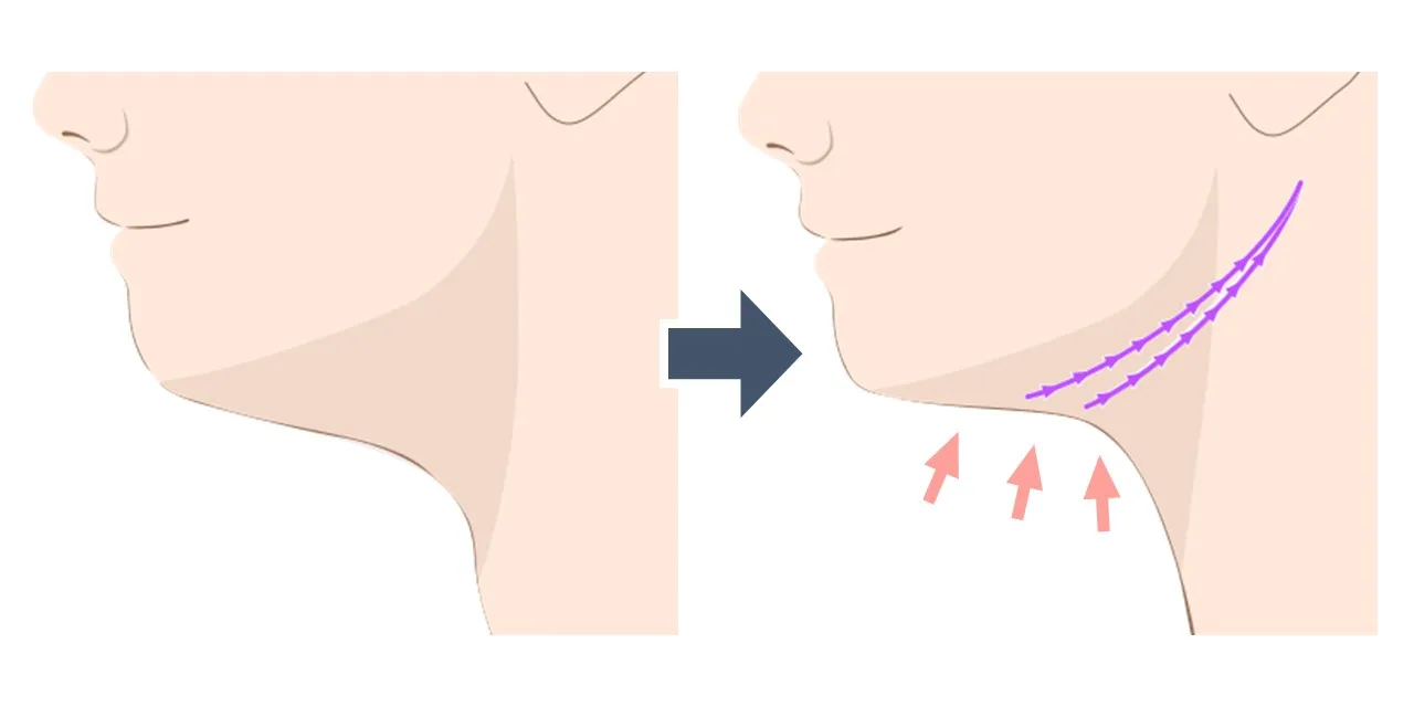 あご下のスレッドリフトの効果のイメージ