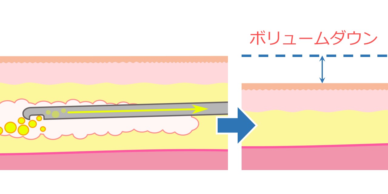 脂肪吸引により皮下脂肪が減少するイメージ
