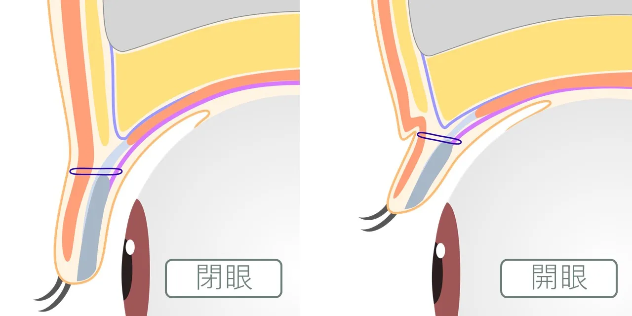 二重埋没法のしくみと、開眼・閉眼時の内部の状態