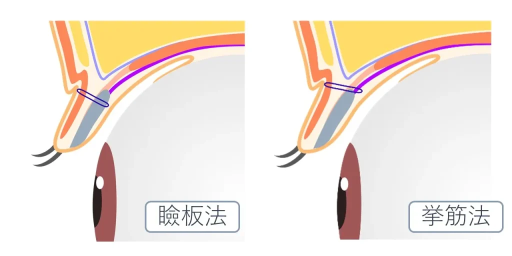 二重埋没法における挙筋法と瞼板法の糸のかける位置の違い