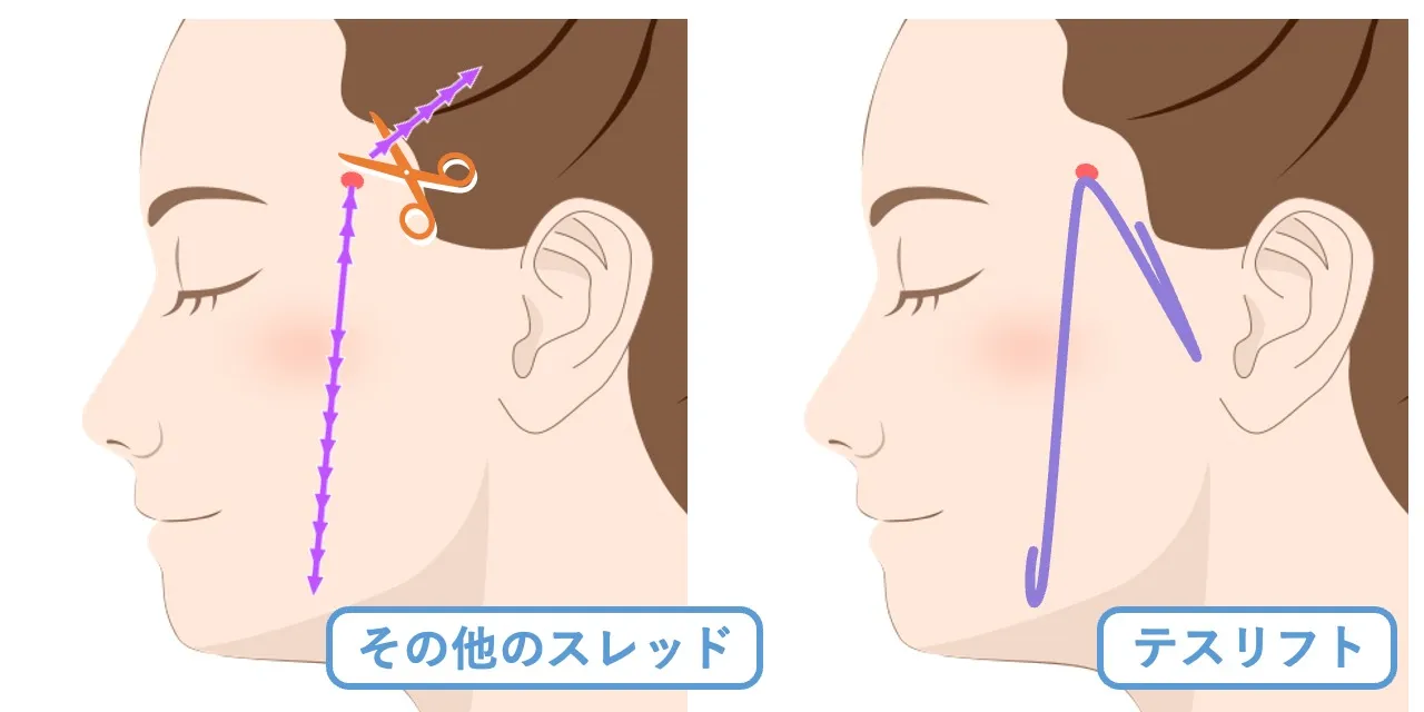 スレッドリフトの『テスリフト』は折り返して挿入することで、後戻りを低減させる作用があります