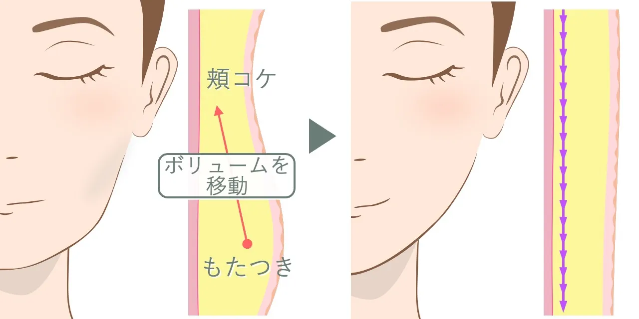 スレッドリフトで脂肪のボリュームを移動させることで、フェイスラインのもたつきと頬コケをフラットに整えるイメージ