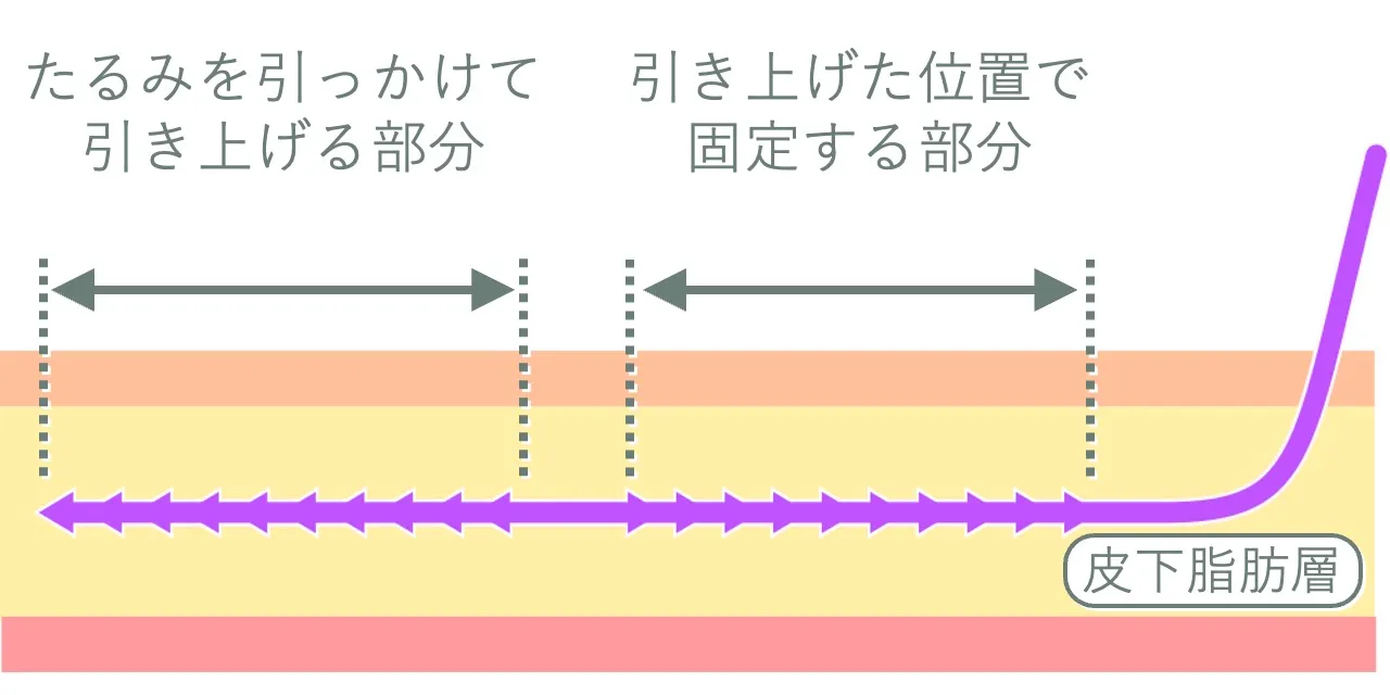 スレッドリフトのコグは、その向きによって組織に引っかかる役割と、引き上げた位置に固定する役割を持つ