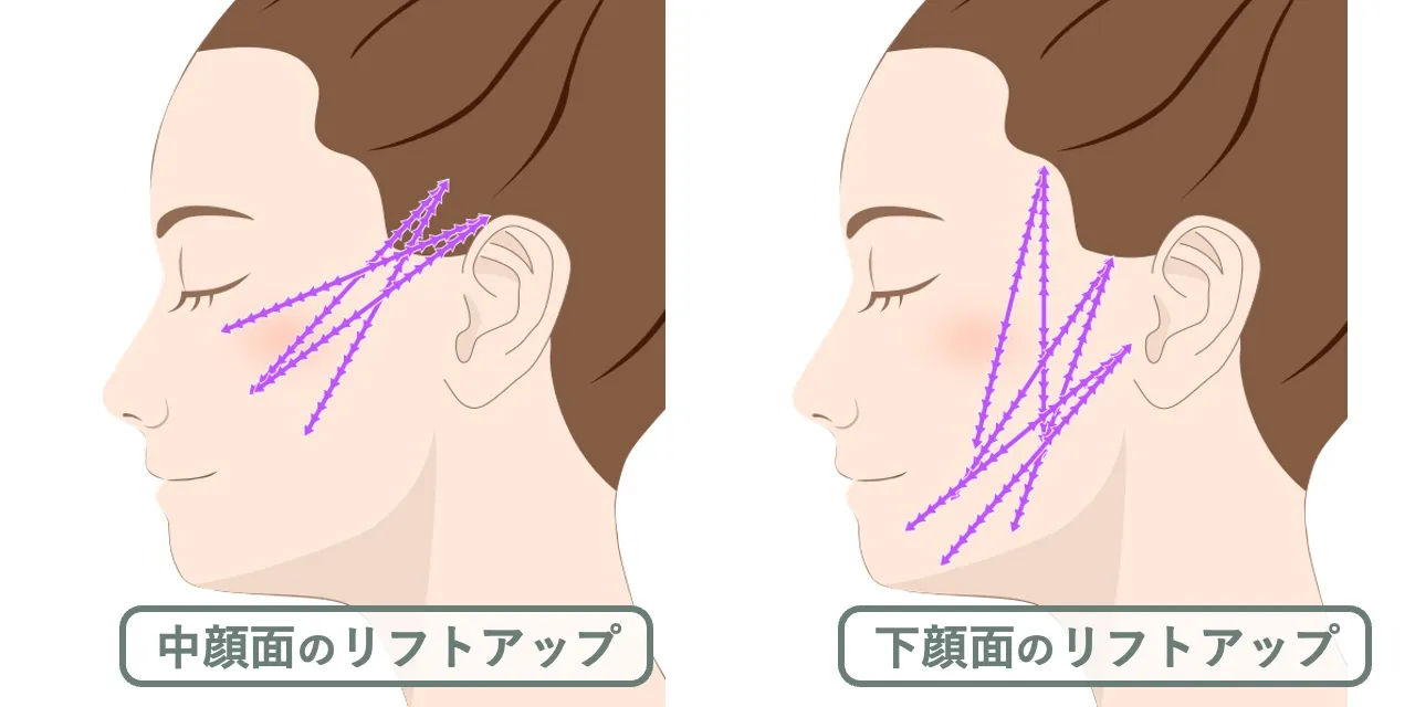目的に合わせたスレッドの入れ方｜中顔面と下顔面のリフトアップを目的とする場合の挿入デザイン