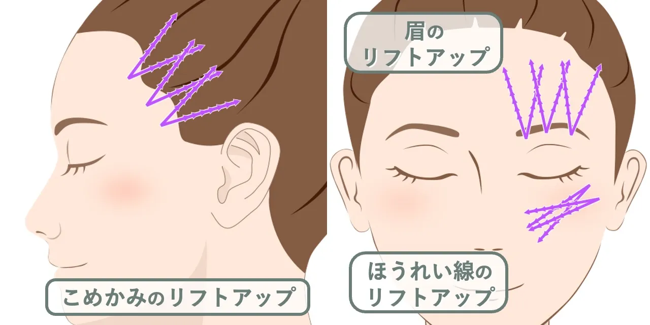 目的に合わせたスレッドの入れ方｜こめかみ、眉、ほうれい線のリフトアップを目的とする場合の挿入デザイン