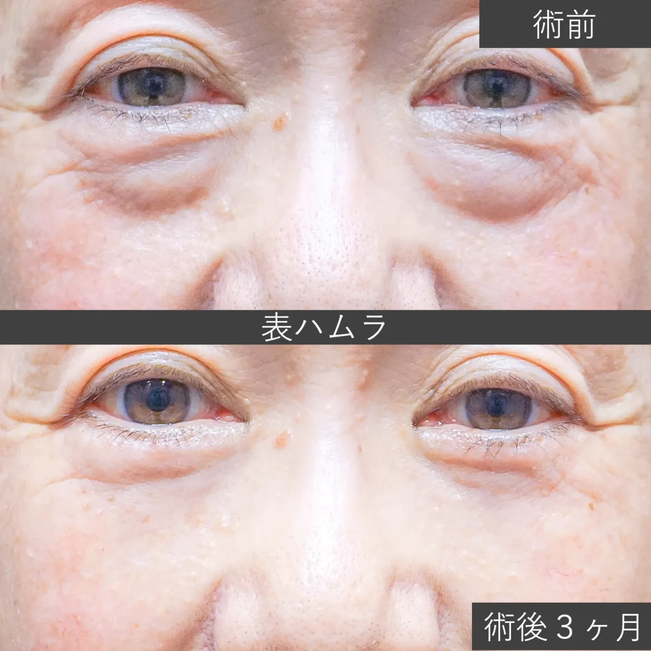 【クマ治療】表ハムラ（経皮的眼窩脂肪移動術）の症例写真｜施術前と施術1ヶ月後の下まぶたの比較