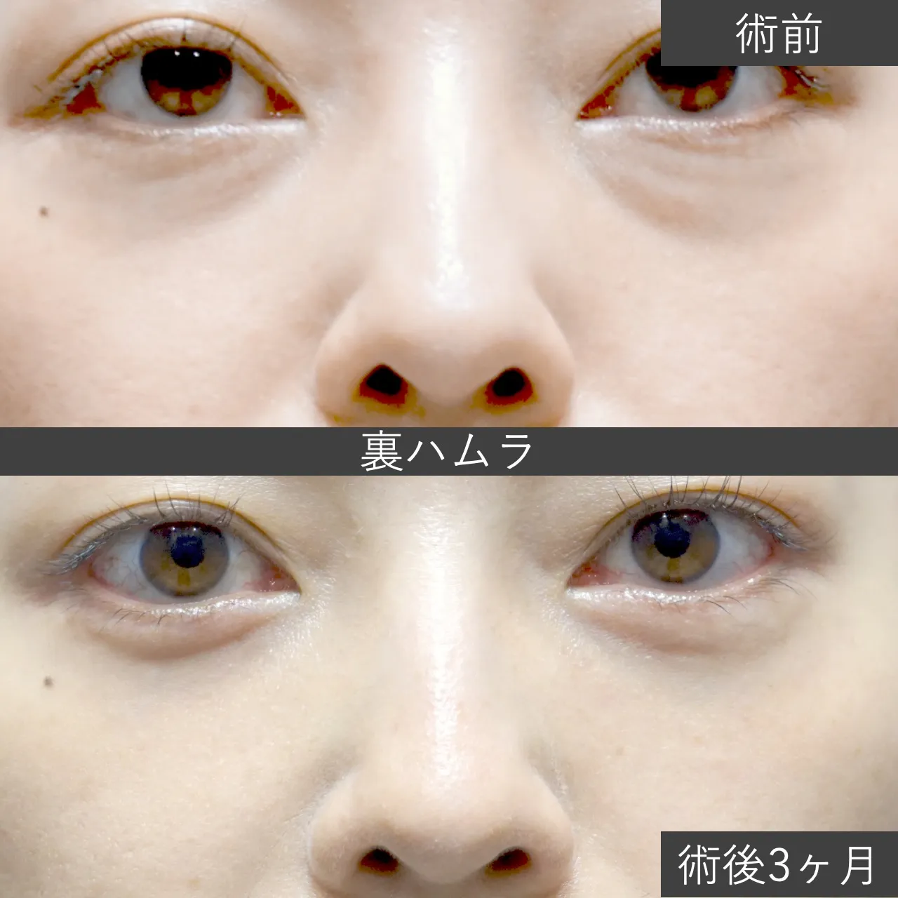 【クマ治療】裏ハムラ（経結膜的眼窩脂肪移動術）の症例写真｜施術前と施術3ヶ月後の下まぶたの比較