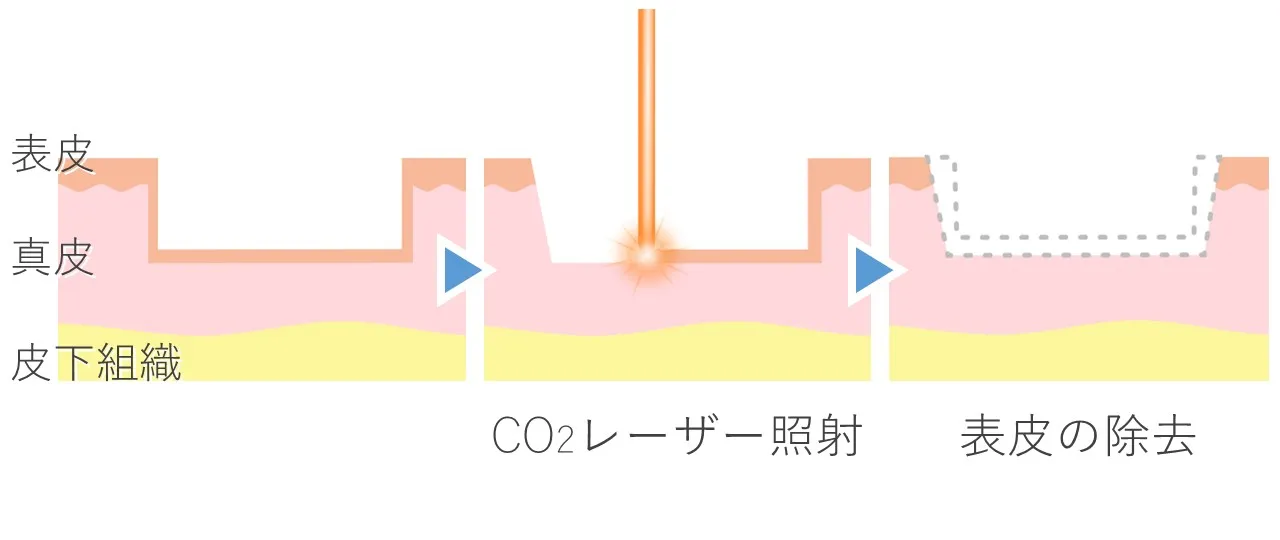 アブレージョンの治療原理イメージ