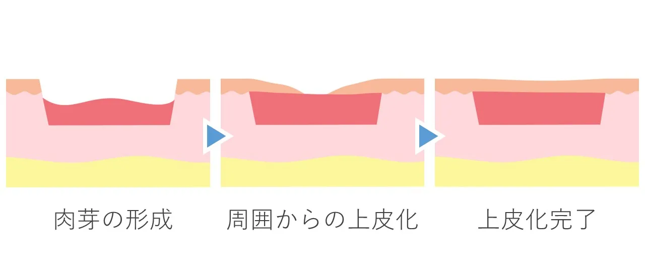アブレージョン後に形成される肉芽組織が、欠損した真皮を埋め、へこみを平坦化させる様子