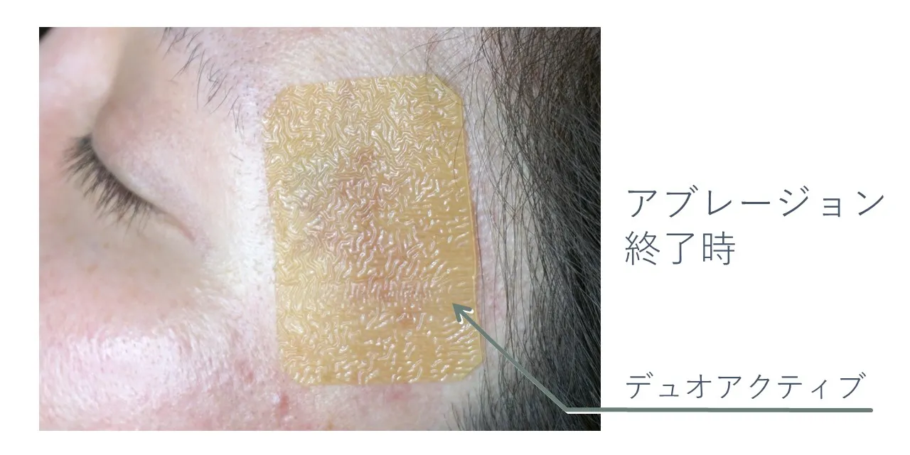 アブレージョン後にデュオアクティブを貼付した状態