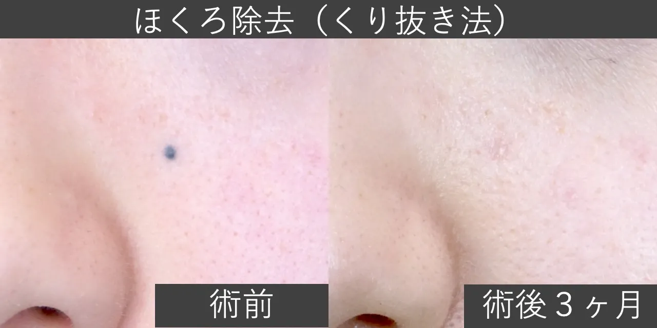【症例写真】ほくろ除去（くり抜き法）の施術前と3ヶ月後