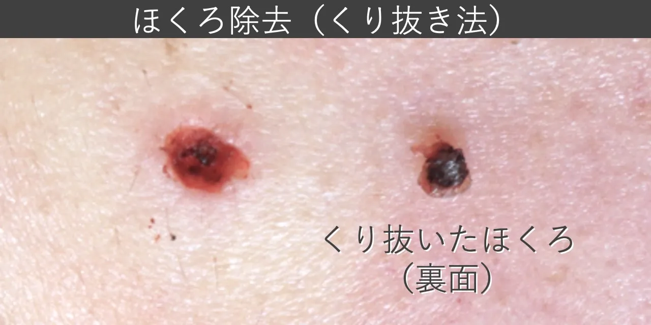 【症例写真】ほくろ除去(くり抜き法) 施術直後の状態と、除去したほくろ