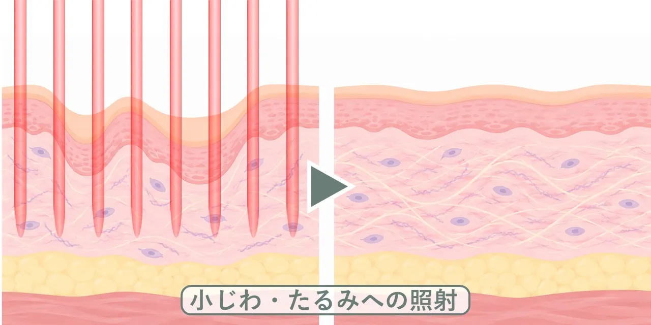 たるんでシワのある皮膚にCO2フラクショナルレーザーを照射し、たるみ・シワが軽減するイメージ