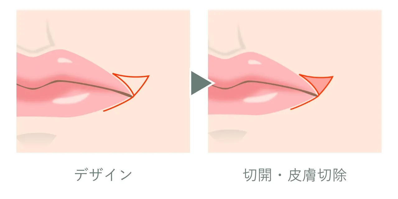 口角挙上の切開線と皮膚切除範囲のデザイン