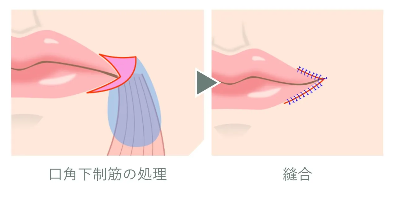 口角下制筋の処理と口角の移動を示すイラスト