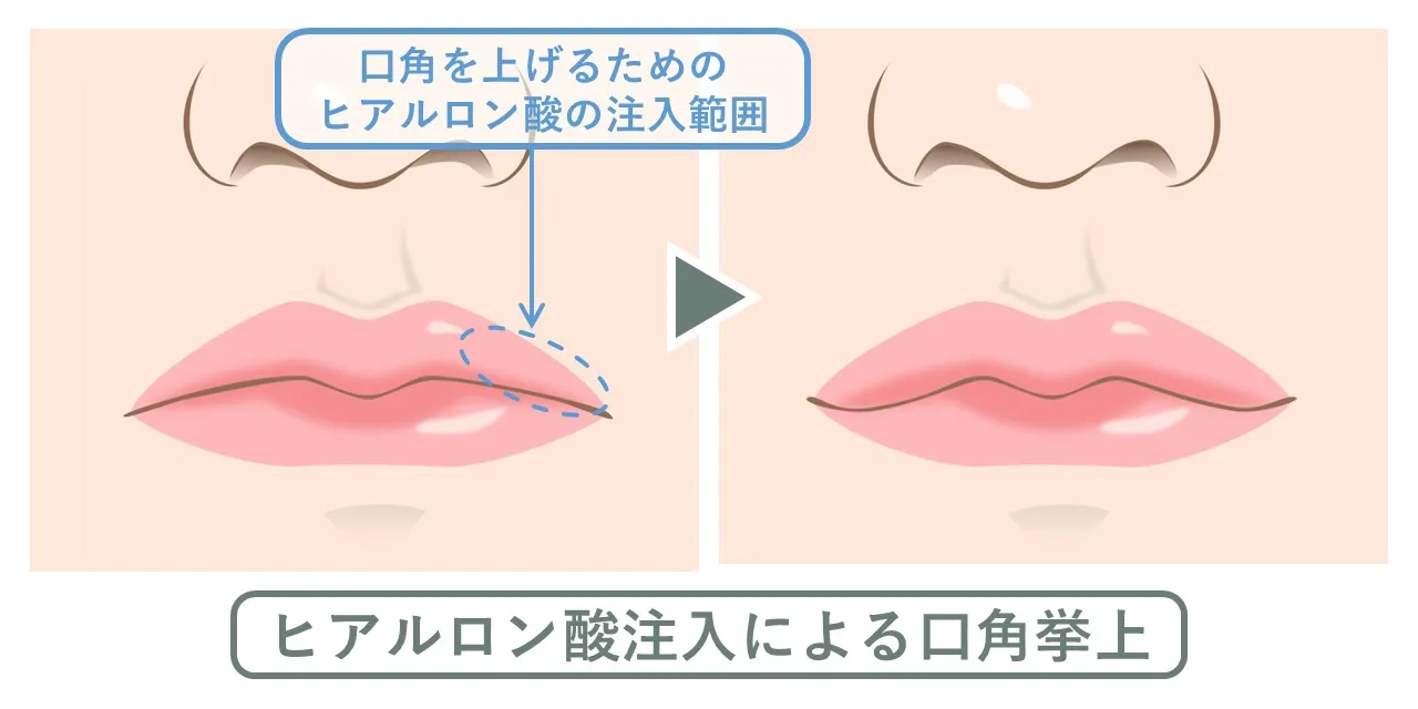 ヒアルロン酸注入で口角を上げる方法