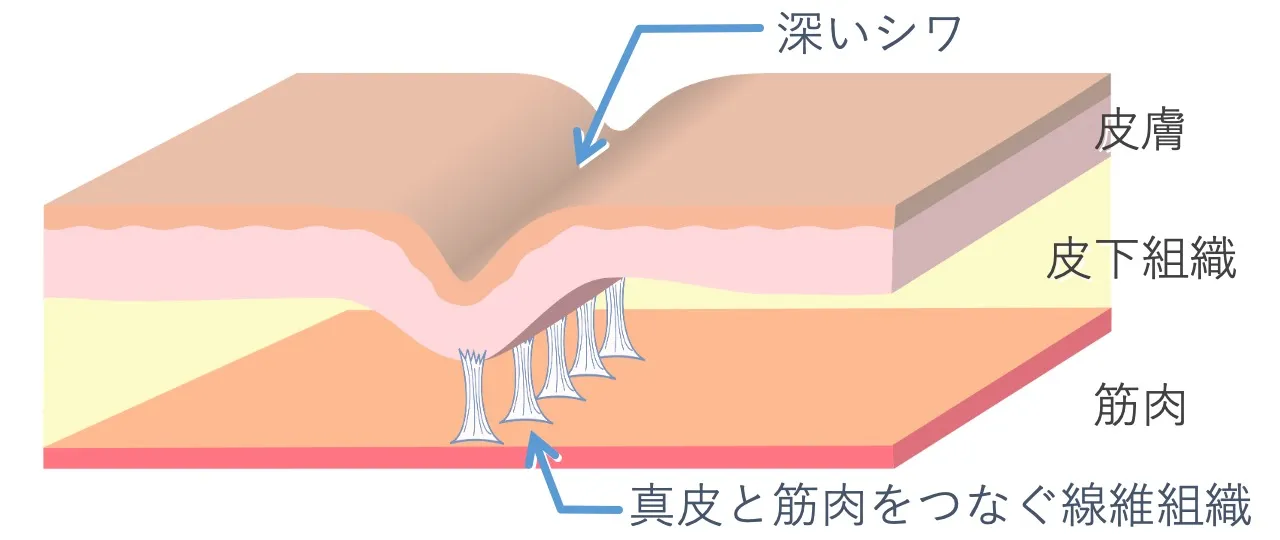 深いシワをヒアルロン酸のみで伸ばそうとしても、固く短い線維組織はあまり伸びないので、シワの改善効果が不十分に終わることがあります。