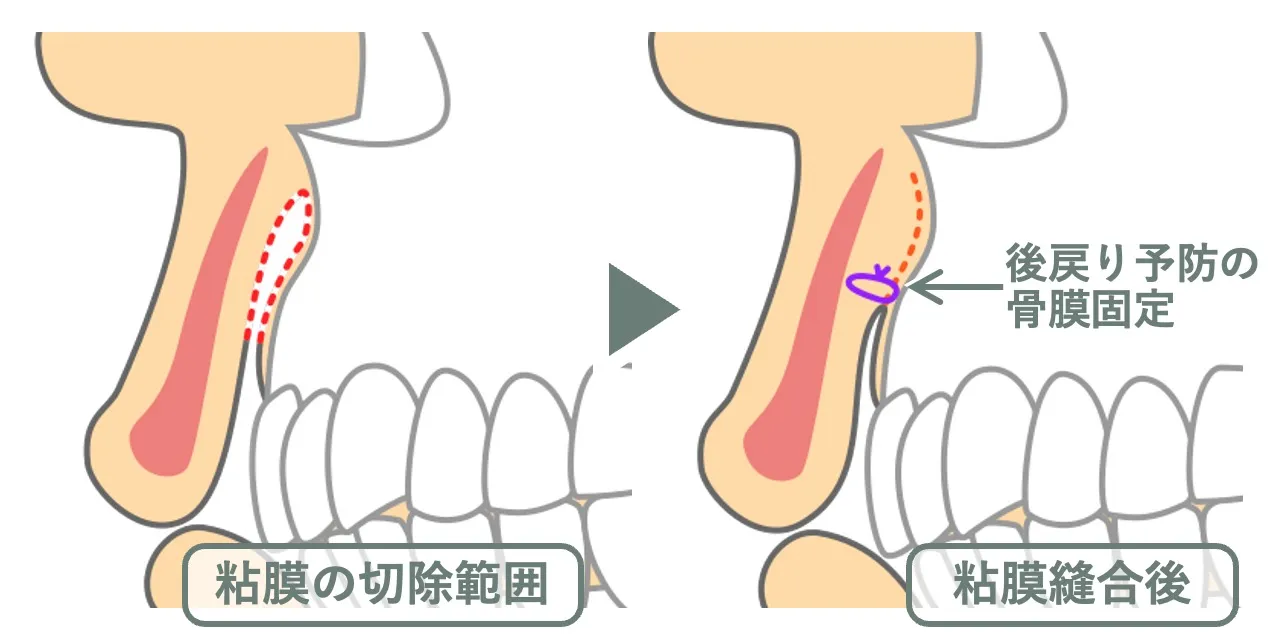 ガミースマイル治療で上唇の粘膜を切除し、後戻り予防の骨膜固定を行う位置