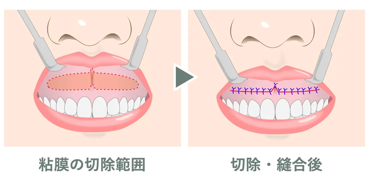 ガミースマイル手術における粘膜の切除範囲