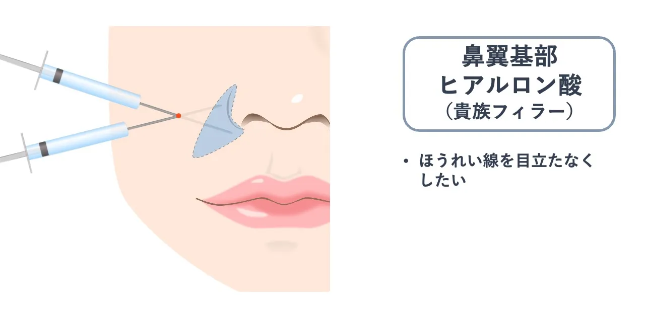 鼻翼基部ヒアルロン酸（貴族フィーラー）