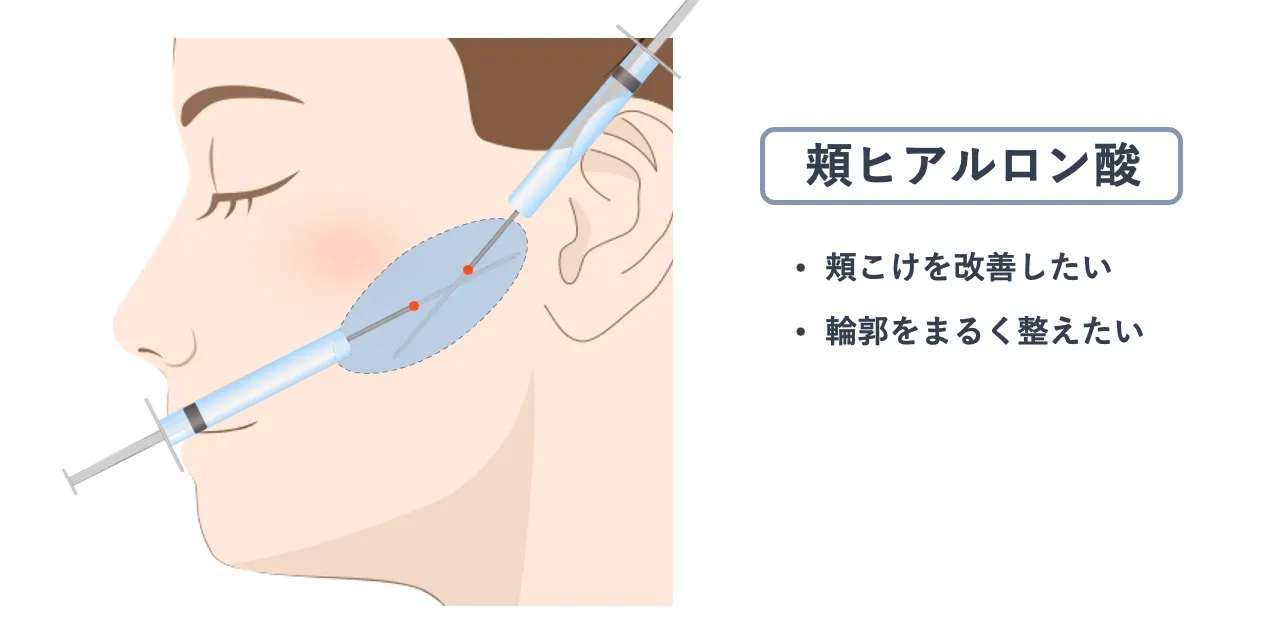 頬ヒアルロン酸