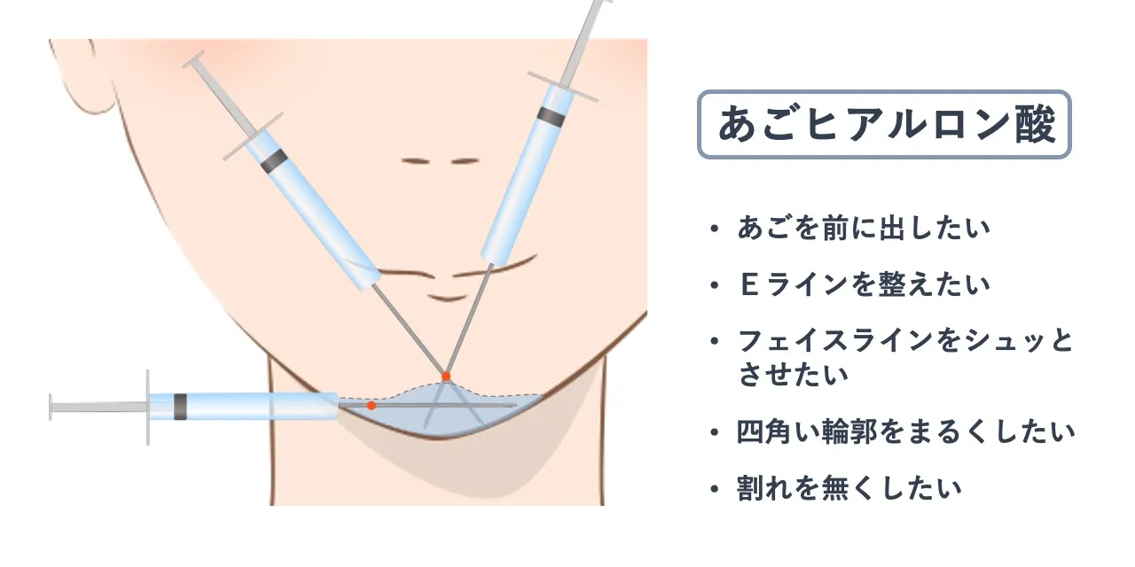 あごヒアルロン酸