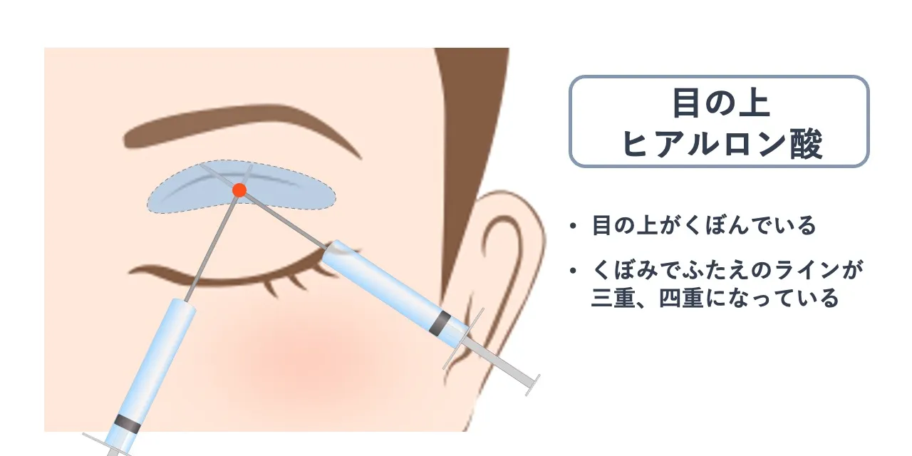 目の上ヒアルロン酸