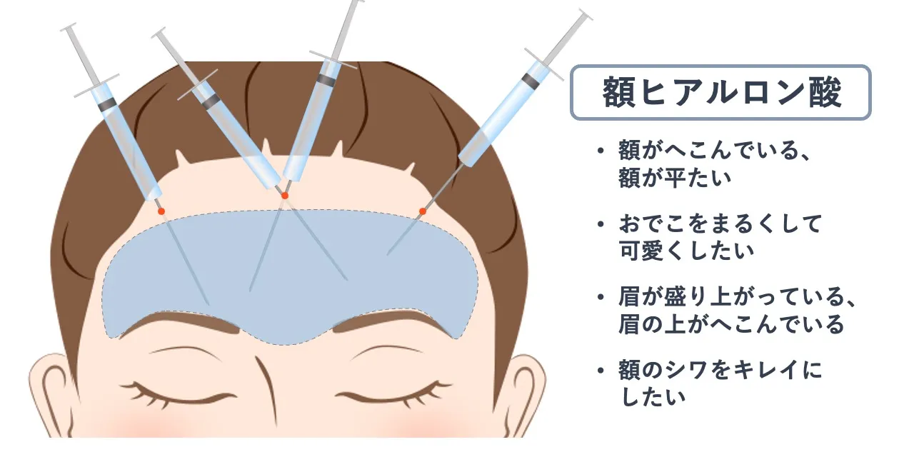 額ヒアルロン酸