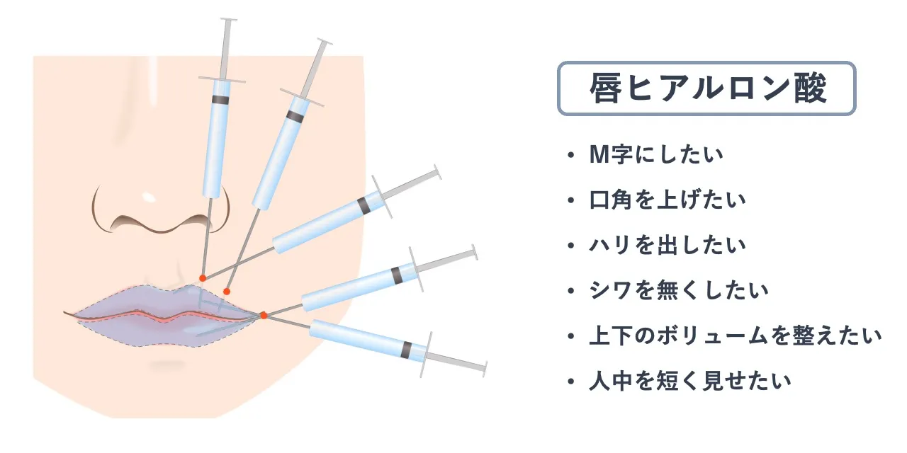唇ヒアルロン酸