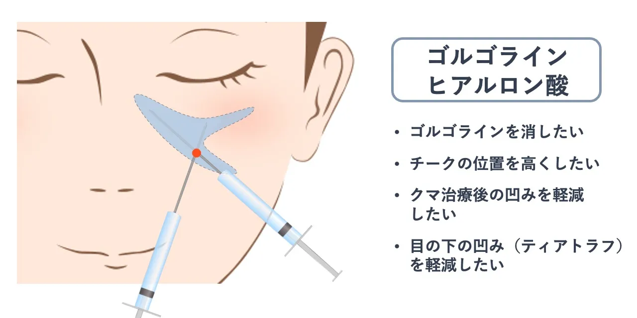 ゴルゴラインヒアルロン酸