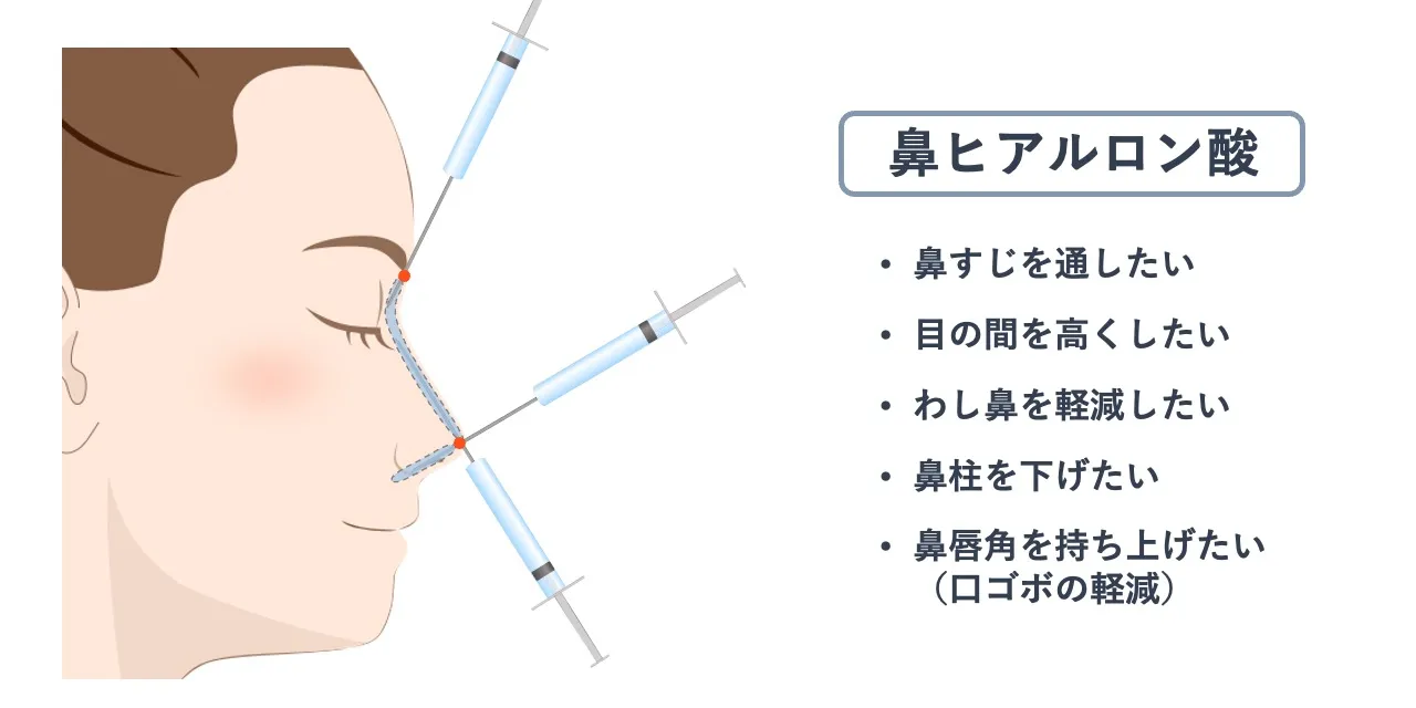 鼻ヒアルロン酸