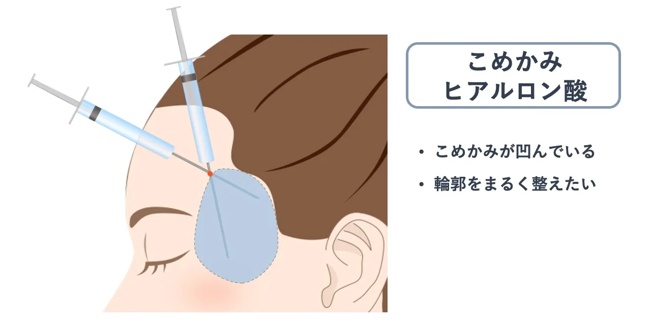 こめかみヒアルロン酸