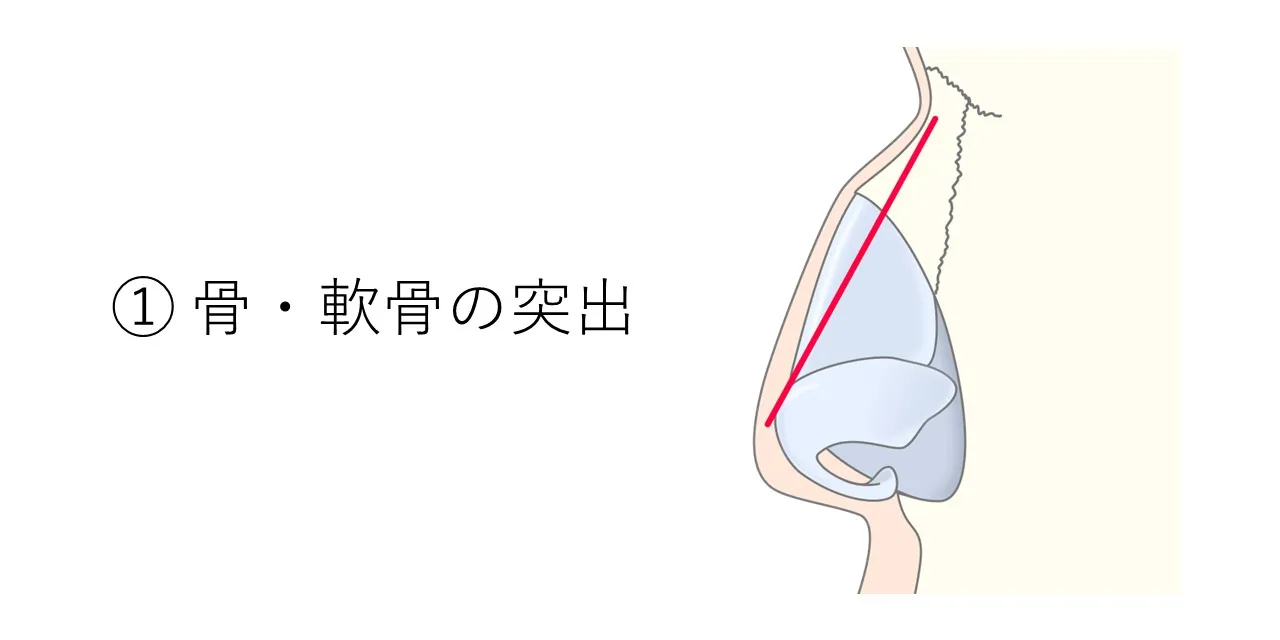 鼻骨と鼻軟骨に突出があるタイプの、鼻の骨・軟骨の状態