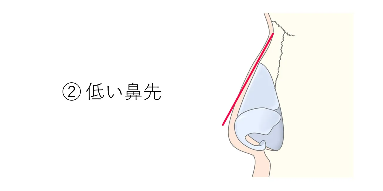 鼻先が低いことでわし鼻を呈するタイプの、鼻の骨・軟骨の状態