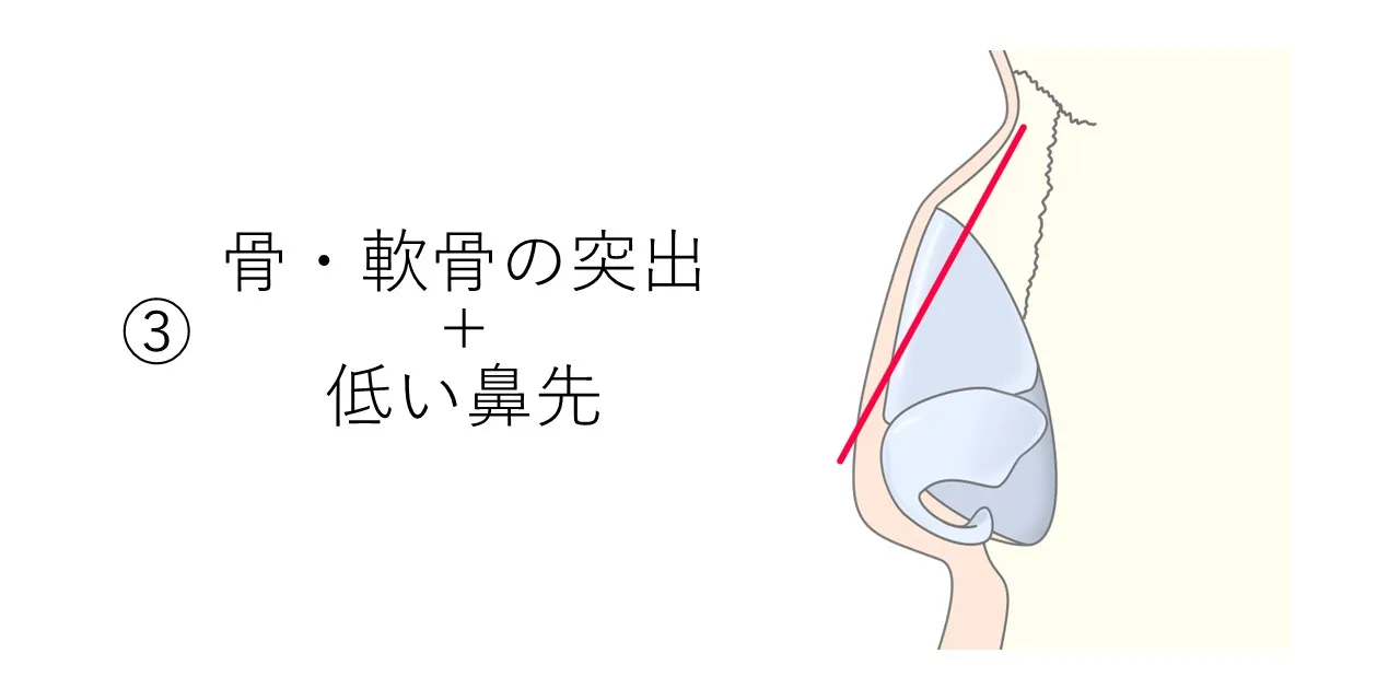 鼻骨と鼻軟骨に突出があり、さらに鼻先が低いタイプの、鼻の骨・軟骨の状態