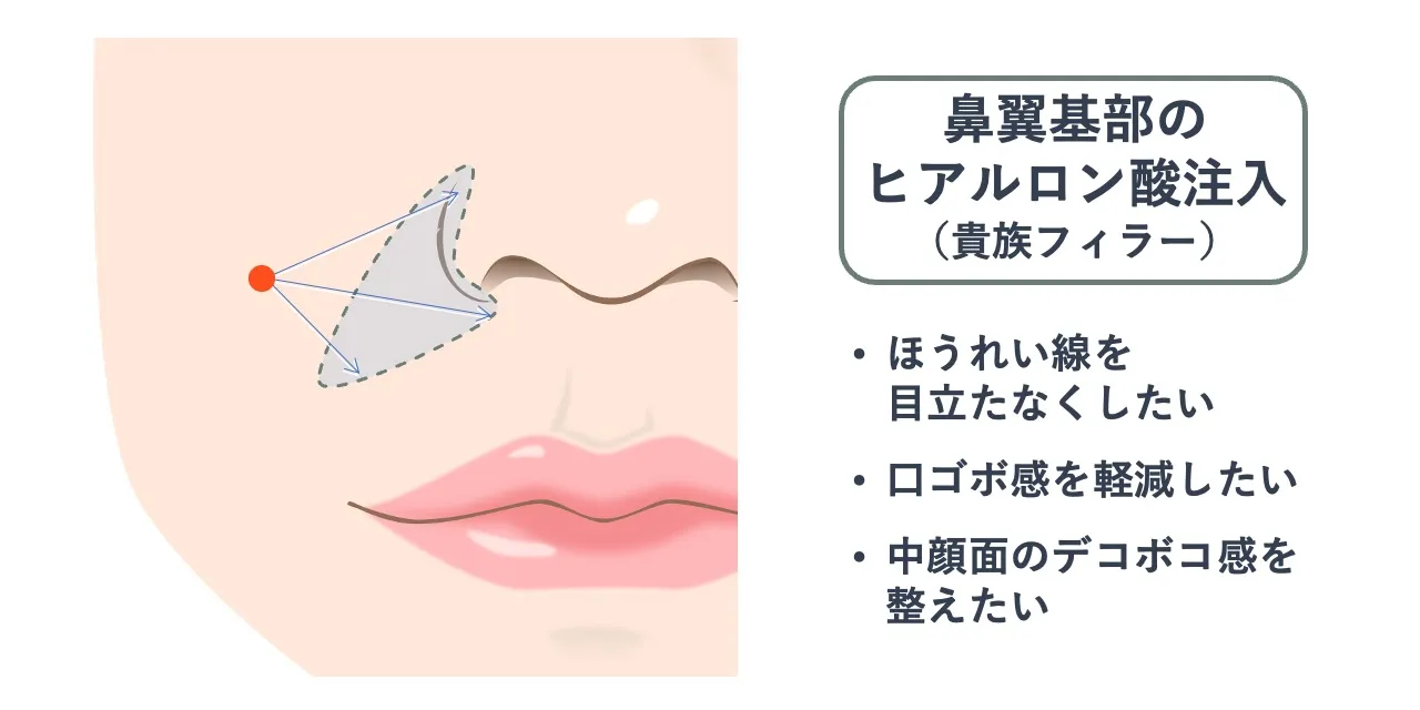 鼻翼基部のヒアルロン酸注入時の針を刺すポイントと注入範囲の目安