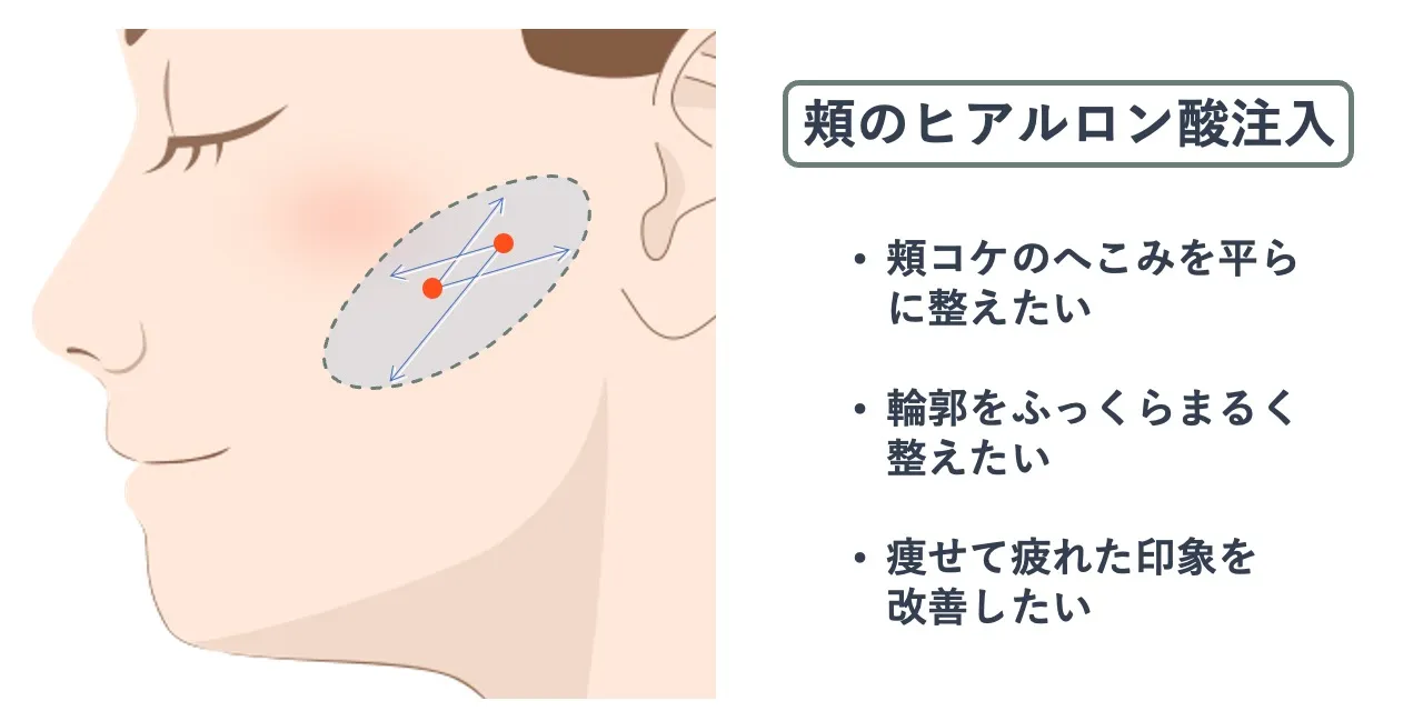 頬のヒアルロン酸注入時の針を刺すポイントと注入範囲の目安