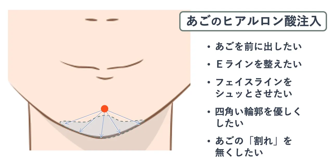あごのヒアルロン酸注入時の針を刺すポイントと注入範囲の目安
