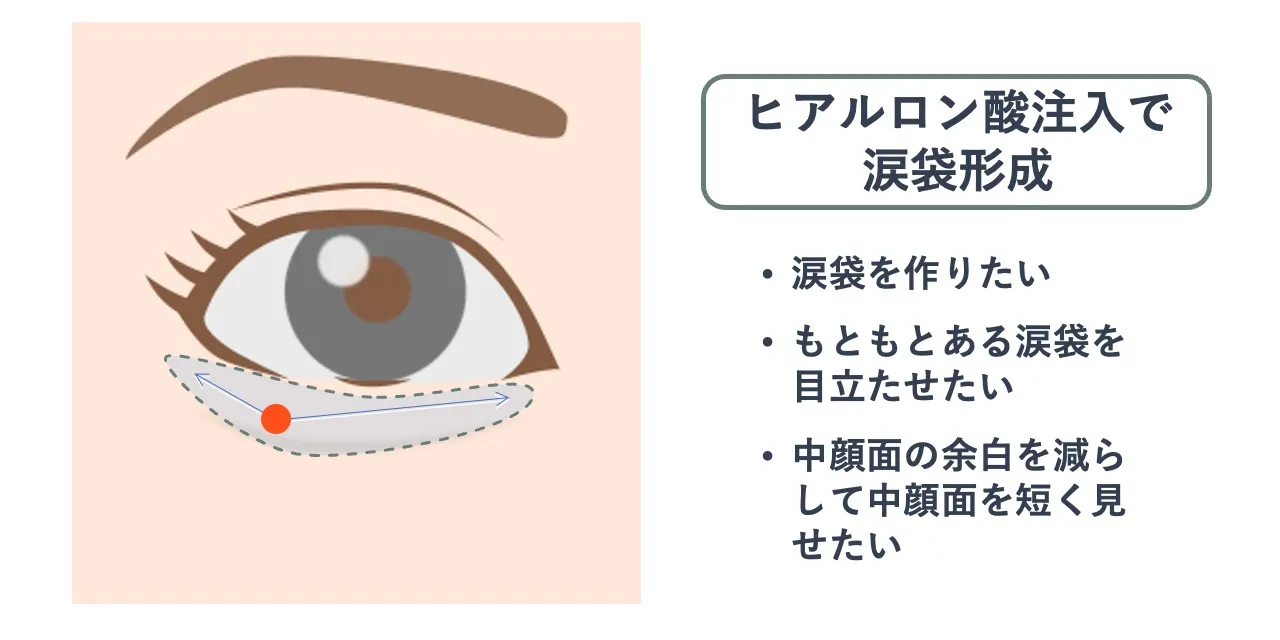涙袋のヒアルロン酸注入時の針を刺すポイントと注入範囲の目安