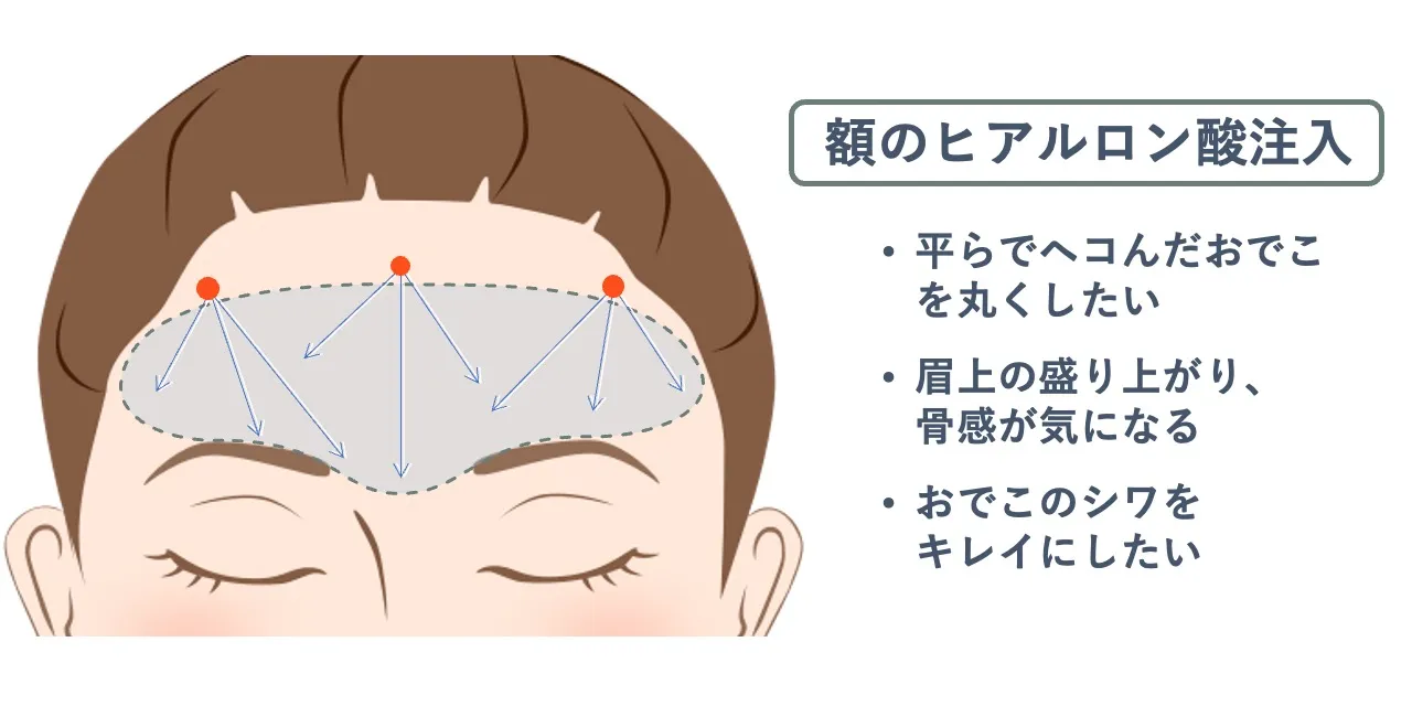 額のヒアルロン酸注入時の針を刺すポイントと注入範囲の目安