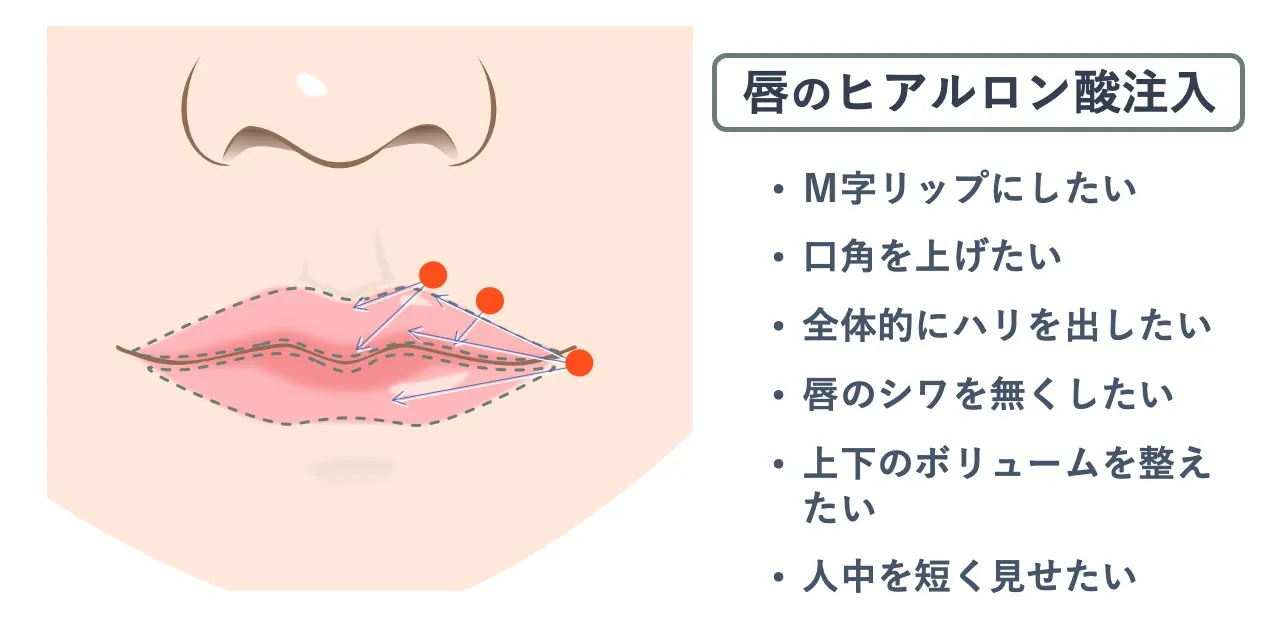 唇のヒアルロン酸注入時の針を刺すポイントと注入範囲の目安