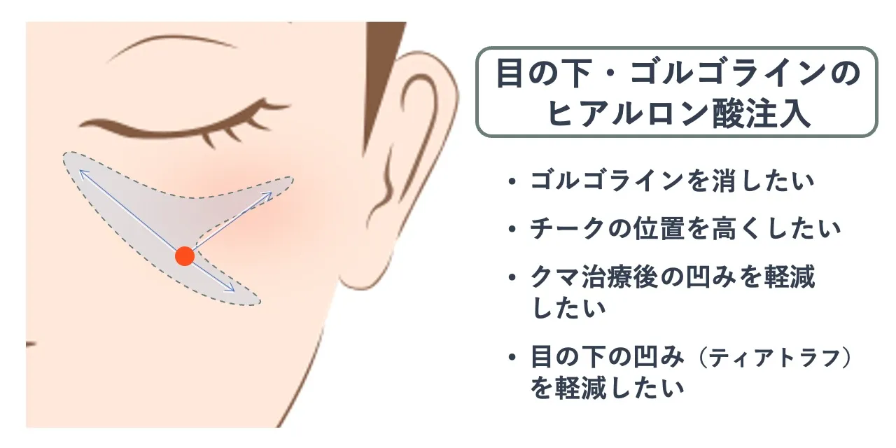 目の下・ゴルゴラインのヒアルロン酸注入時の針を刺すポイントと注入範囲の目安