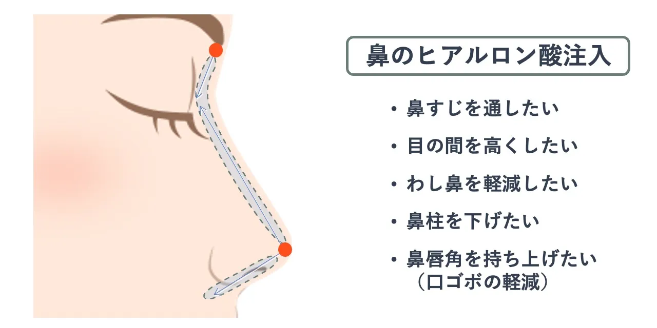 鼻のヒアルロン酸注入時の針を刺すポイントと注入範囲の目安