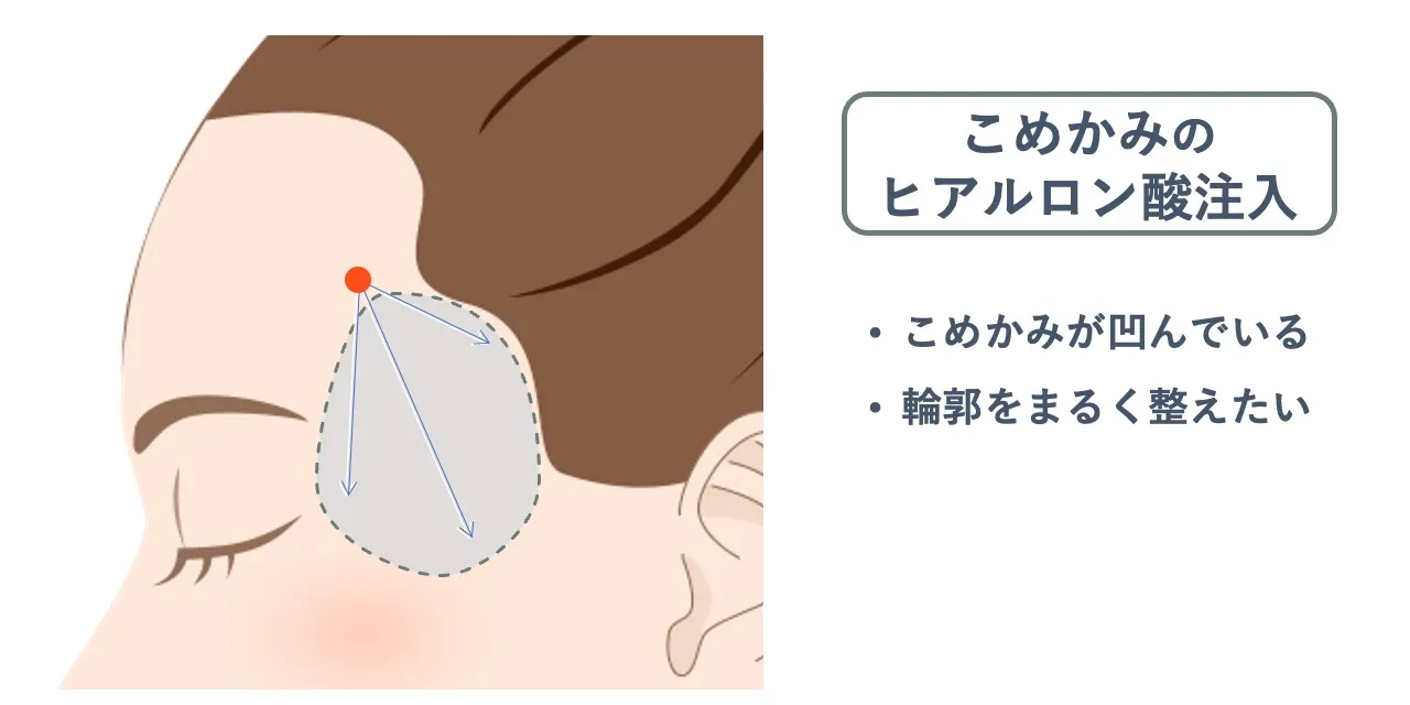 こめかみのヒアルロン酸注入時の針を刺すポイントと注入範囲の目安