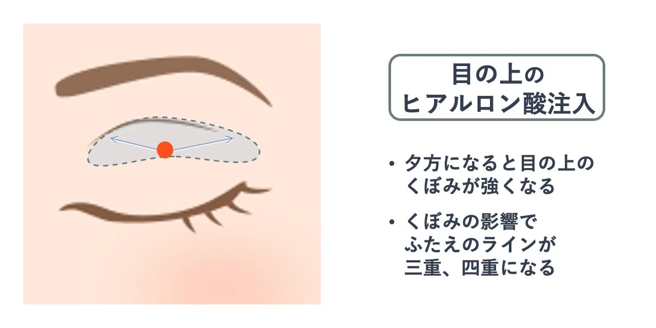 目の上のヒアルロン酸注入時の針を刺すポイントと注入範囲の目安