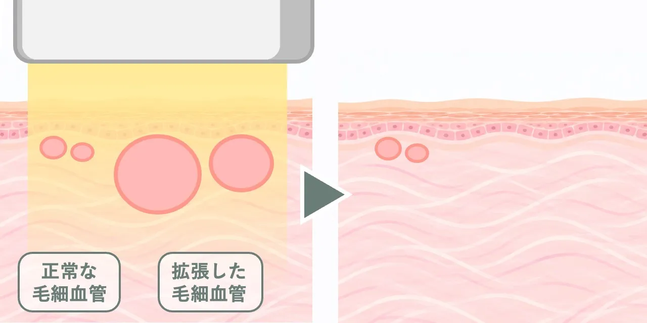 IPLやスペクトラピールの照射によって、拡張した毛細血管がダメージを受けて萎縮する病理組織のイメージ