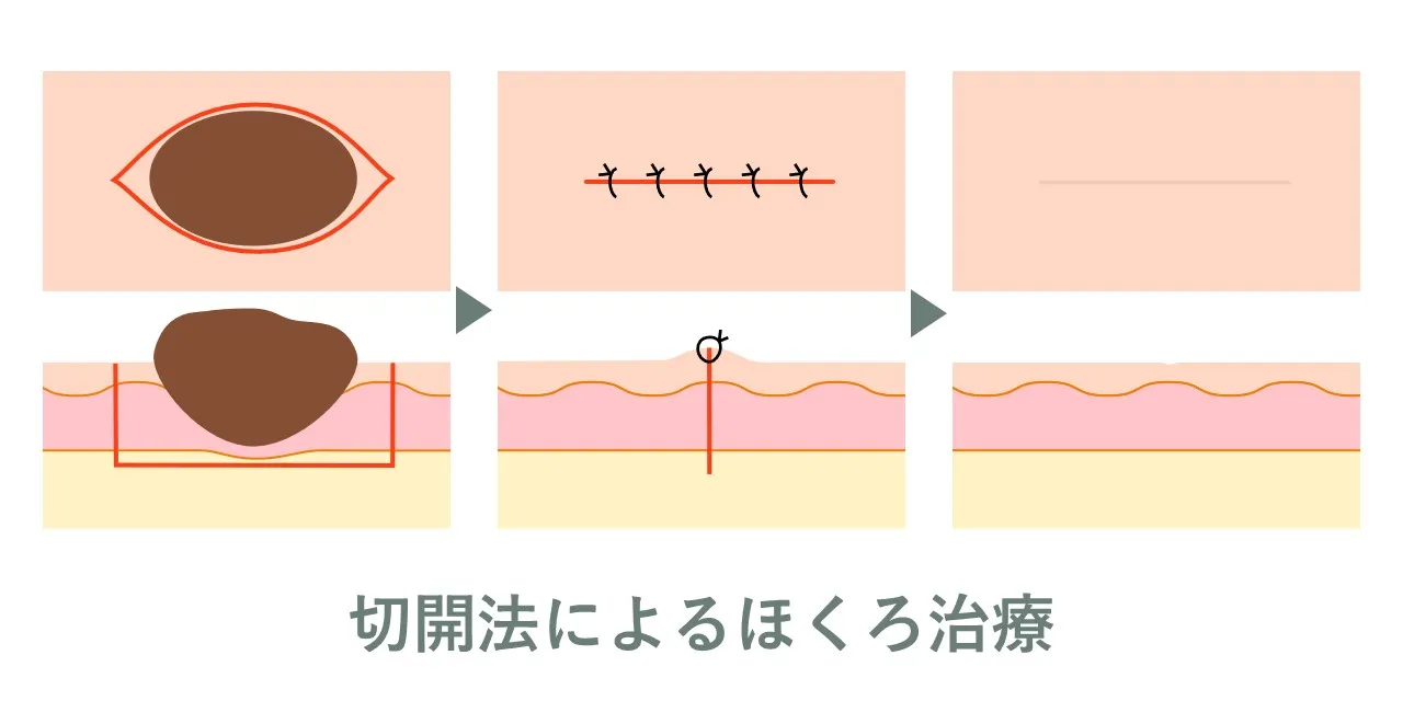 切開法によるホクロ切除の流れ