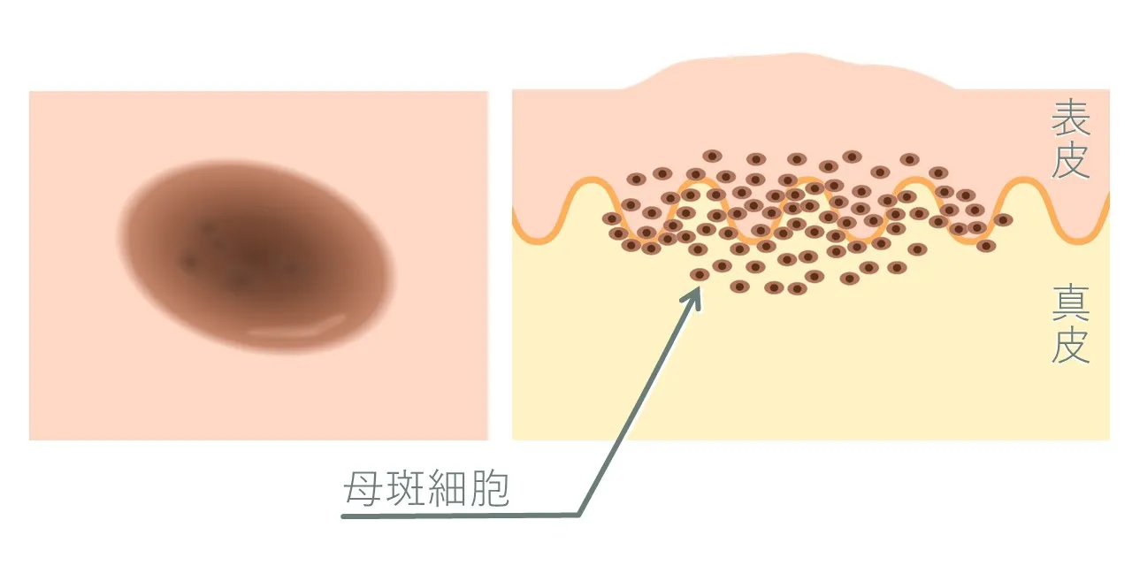 ホクロ(色素性母斑)の病理イラスト
