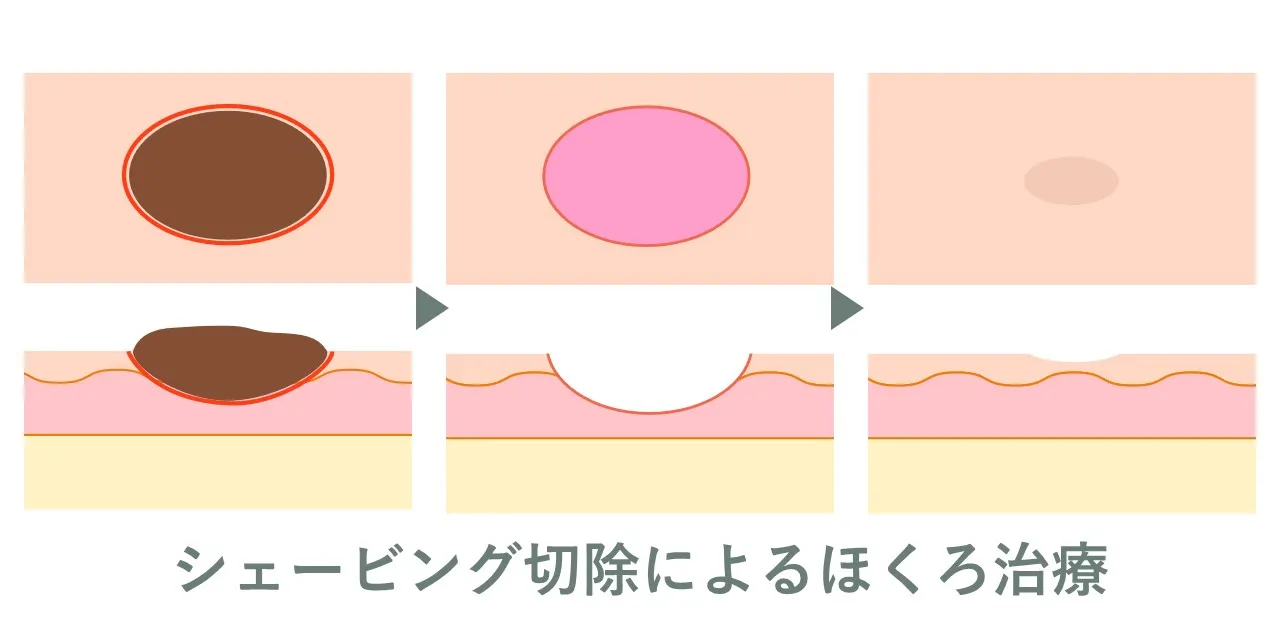 シェービング法によるホクロ除去の流れ