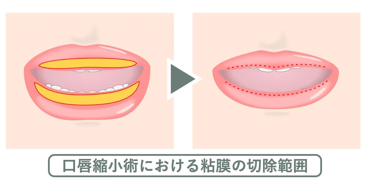 口唇縮小術の粘膜の切除範囲と、縫合の傷あとの位置